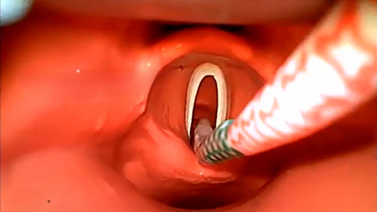 NORA Airway Management Risk Mitigation